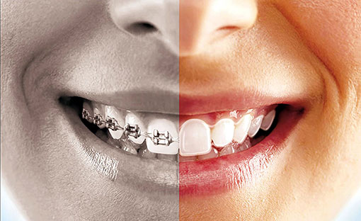Invisalign vs metal braces