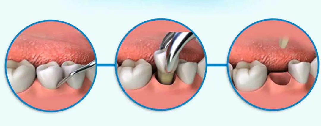 Stages of Tooth Extraction 