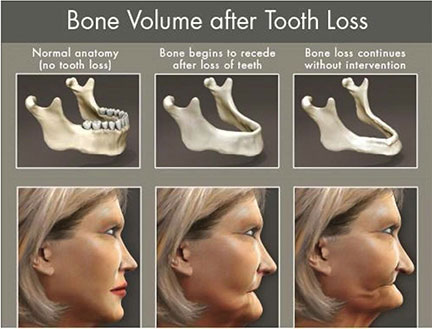 Dental Implants Bone Volume Tooth Loss