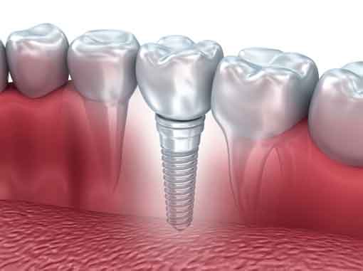 Dental Implants