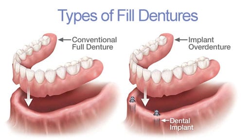 Dental Implants | Peterborough | Dr. Vipin Grover