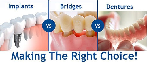 Implants vs Bridges vs Dentures