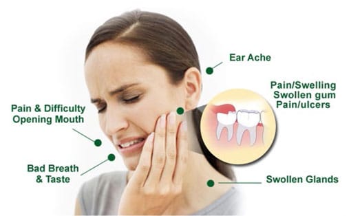 Symptoms of Wisdom Teeth 
